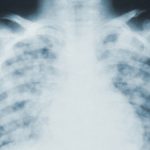 Lung damage found in COVID-19 patients months after infection