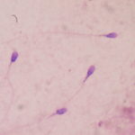 New study suggests COVID-19 reduces male fertility, experts are unconvinced